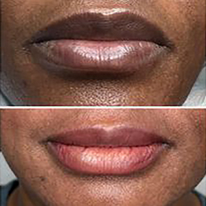 95478 lip neutralization c1