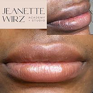95478 lip neutralization c2