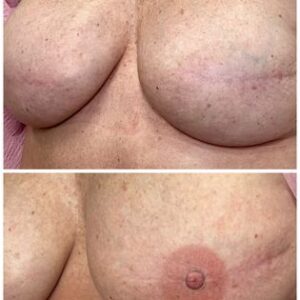 3d-areola-19-300x300